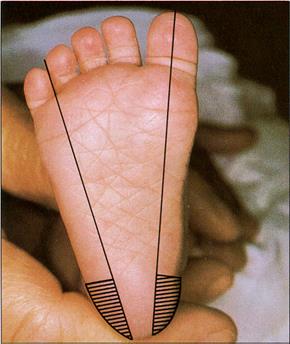 Yenidoğan Bebeklerden Topuk Kanı Nasıl Alınır - Topuk kanı, topuğun iç veya yan yüzlerinden alınıyor